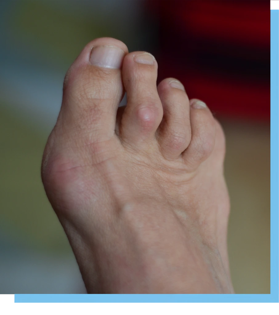 About Hammertoe Doctor Banner