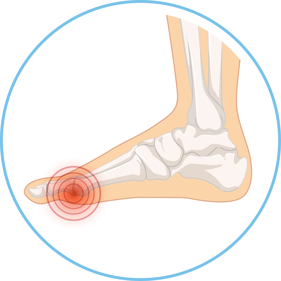 What Is Hallux Limitus? Miami Feet Banner