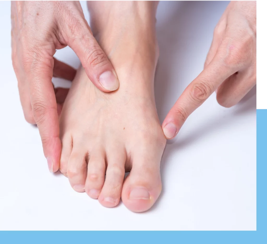 Bunion Surgery in Miami, FL: What Is a Bunion? Banner
