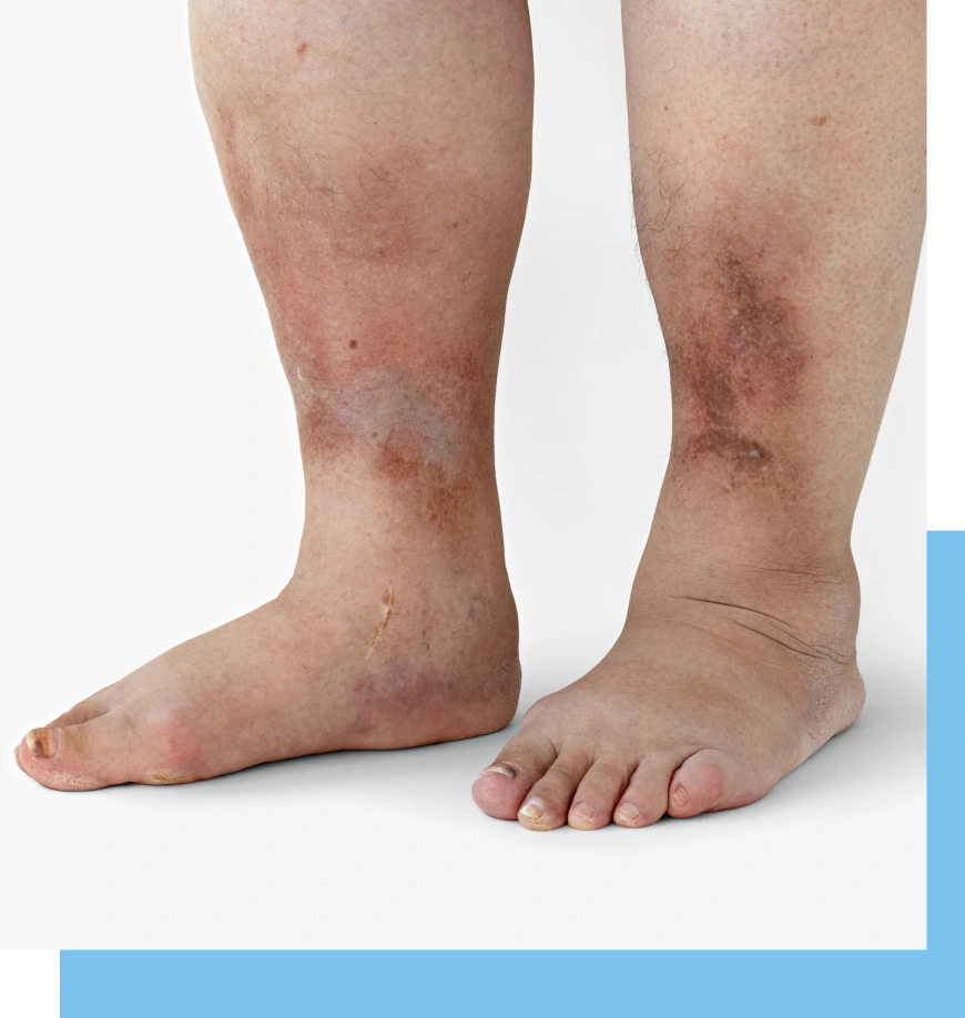 Candidates for Diabetic Foot Treatment Banner