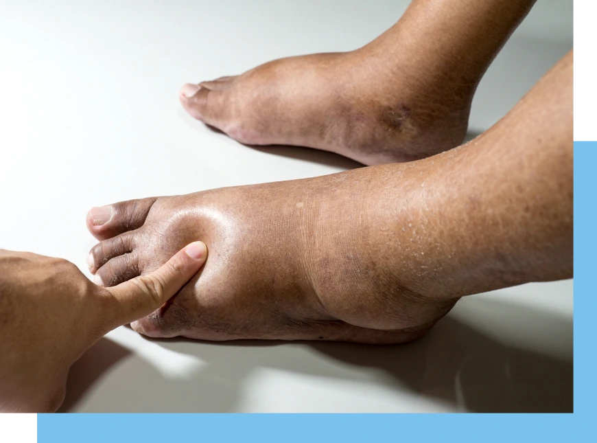 Diabetes Is a Common Cause of Foot Issues Banner