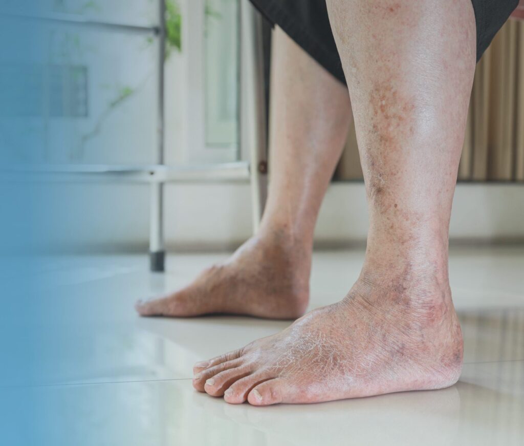 Diabetic Foot Treatment in Miami, FL Banner