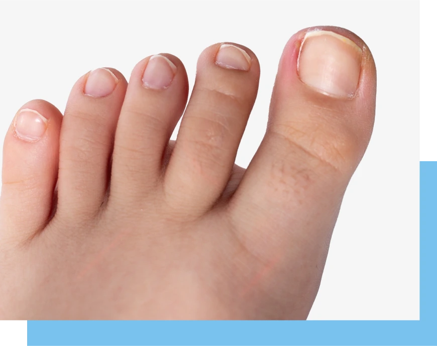 Benefits of Ingrown Nail Treatment Bal Harbour FL Banner