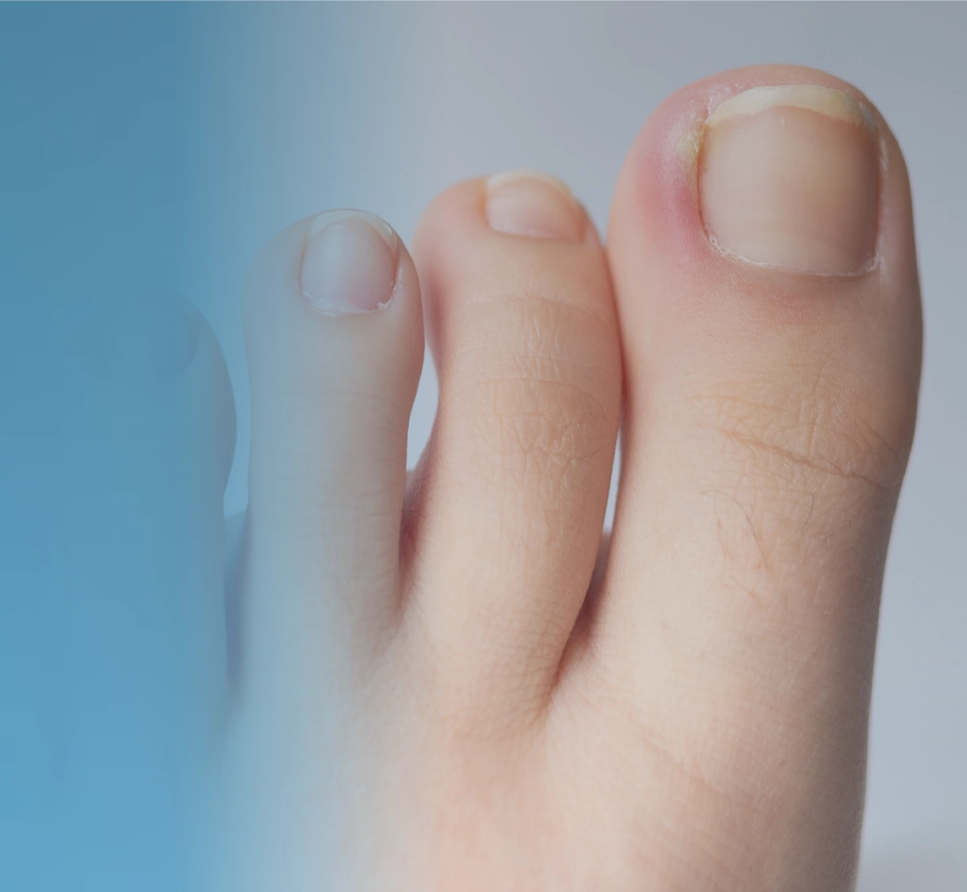 Ingrown Nails Treatment in Bal Harbour, FL Banner