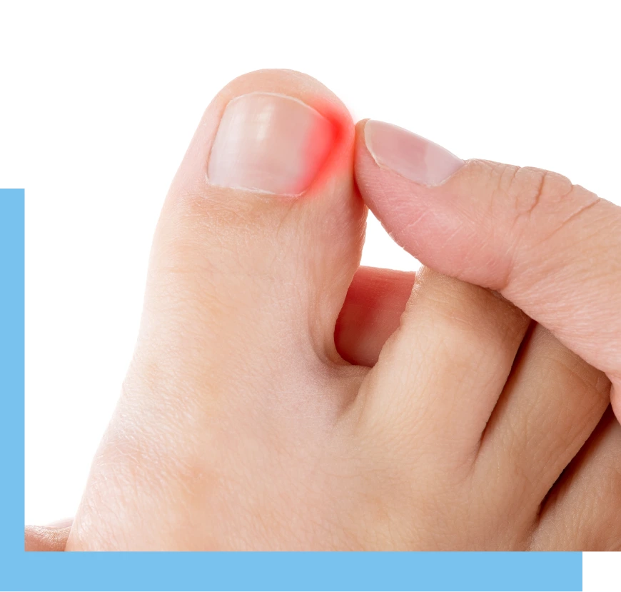What Is an Ingrown Toenail Bal Harbour, FL Banner