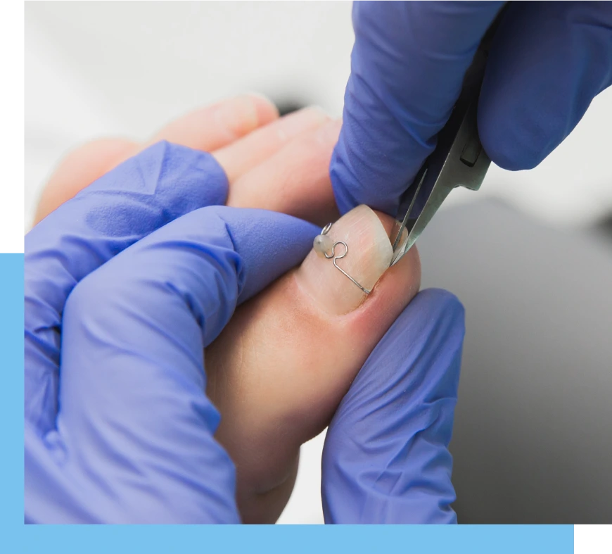 Who Is at Risk of Ingrown Nails Bal Harbour, Florida Banner