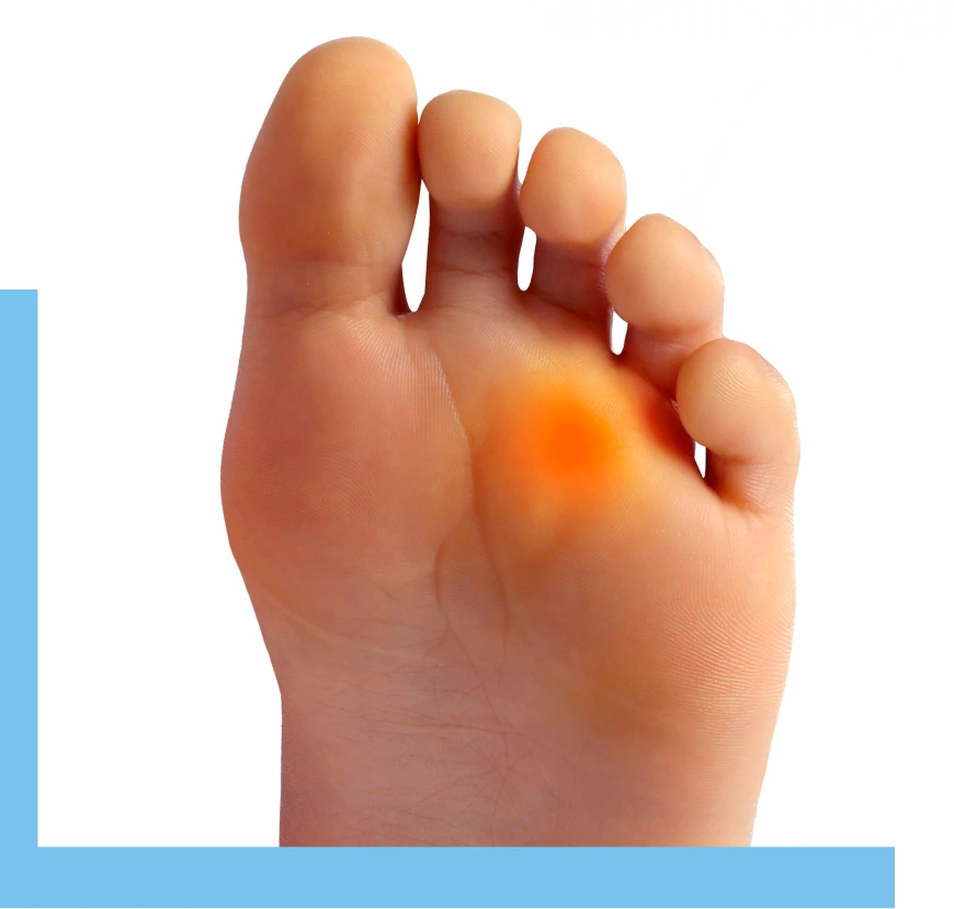 What Is a Neuroma Treatment Surfside, FL Banner