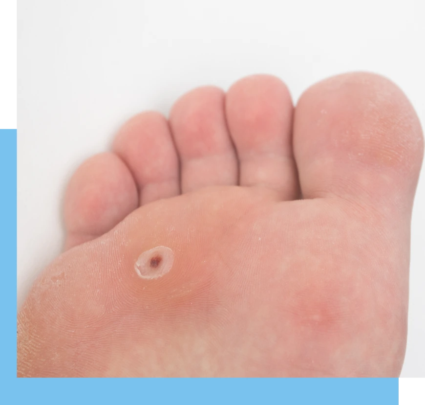 What Is a Plantar Wart Treatment in Surfside, FL Banner